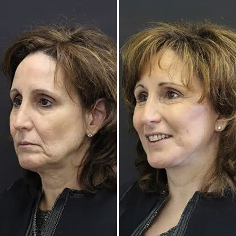 Before & After Photos Nicole Schrader, MD, FACS
