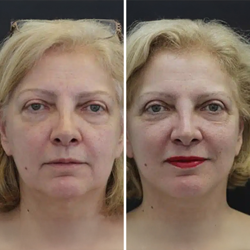 Before & After Photos Nicole Schrader, MD, FACS