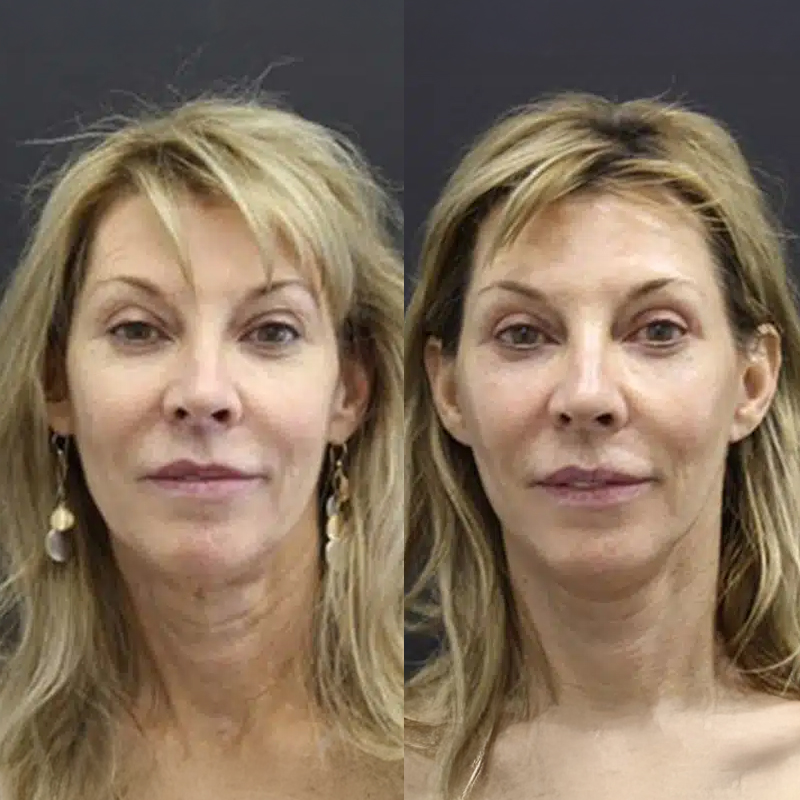 Before & After Photos Nicole Schrader, MD, FACS