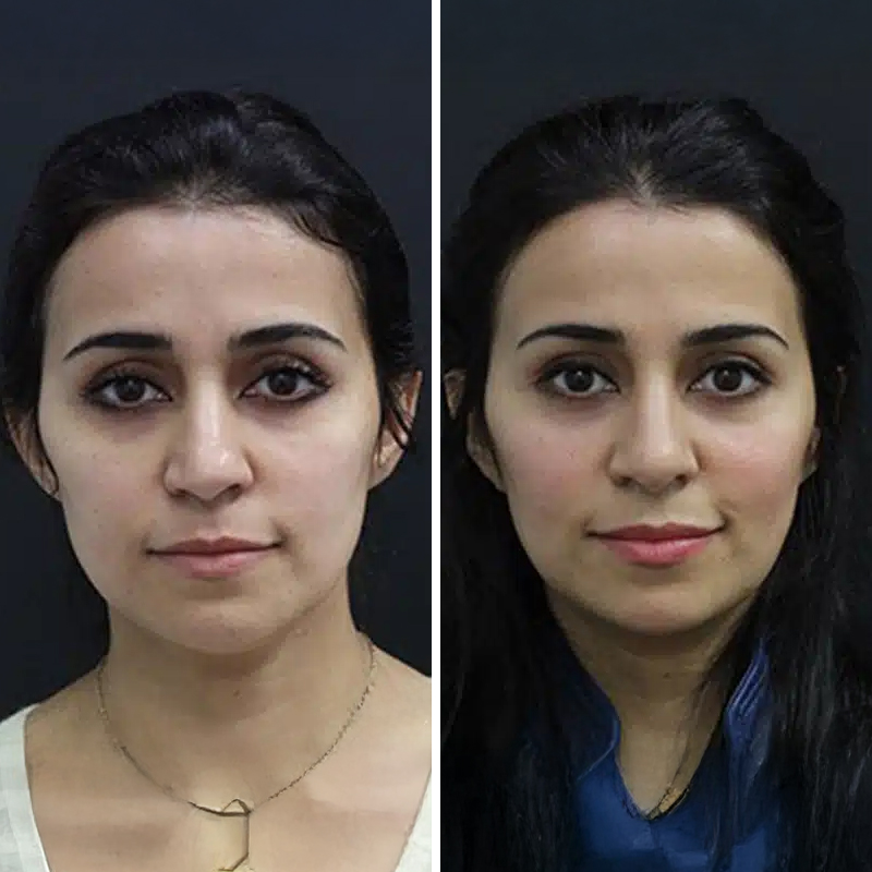 Before & After Photos Nicole Schrader, MD, FACS