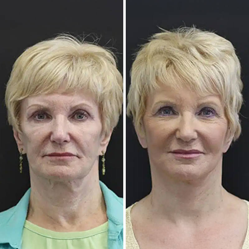 Before & After Photos Nicole Schrader, MD, FACS