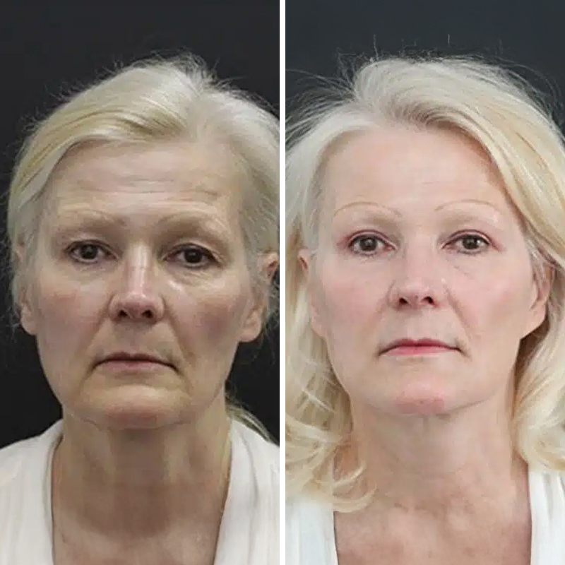 Before & After Photos Nicole Schrader, MD, FACS