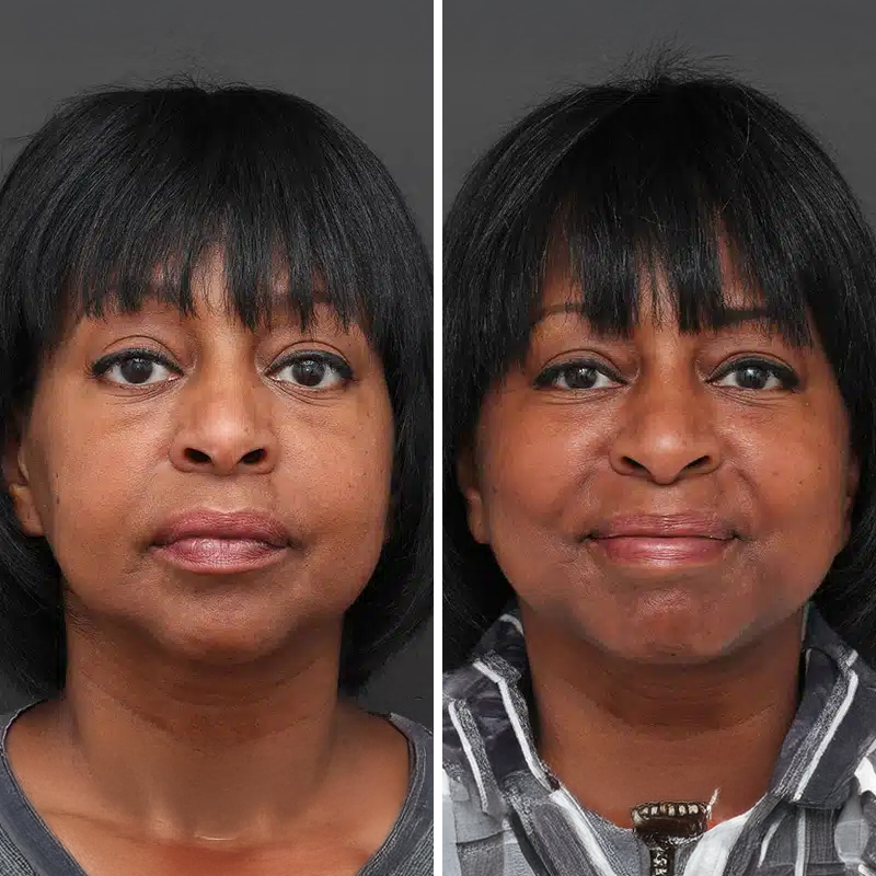 Before & After Photos Nicole Schrader, MD, FACS