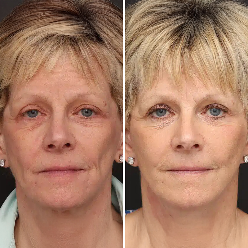 Before & After Photos Nicole Schrader, MD, FACS