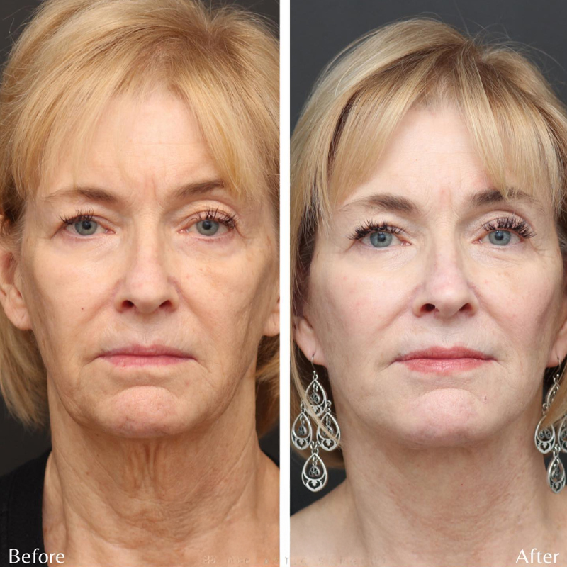 Before & After Photos Nicole Schrader, MD, FACS