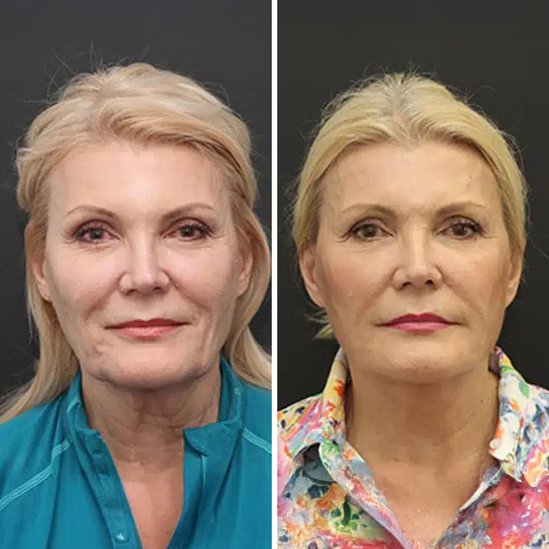Before & After Photos Nicole Schrader, MD, FACS