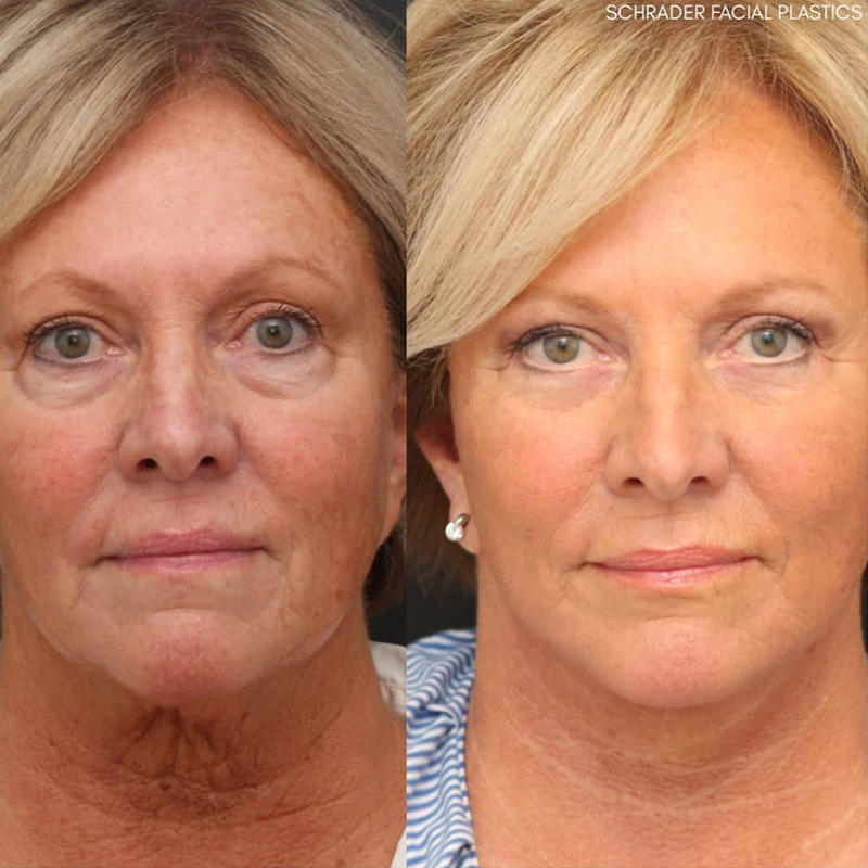Before & After Photos Nicole Schrader, MD, FACS