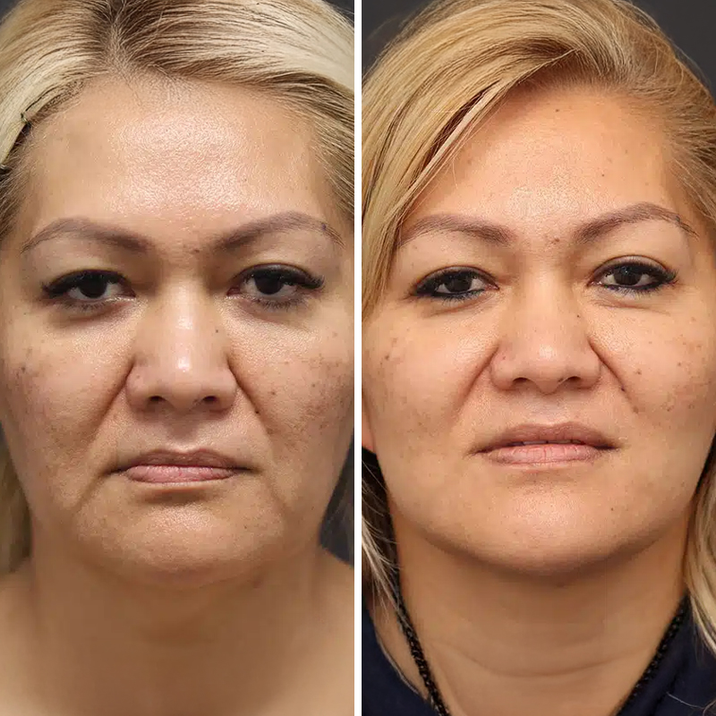 Before & After Photos Nicole Schrader, MD, FACS