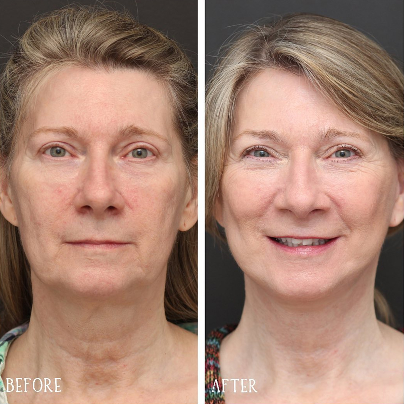 Before & After Photos Nicole Schrader, MD, FACS