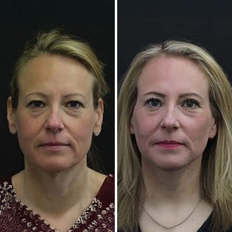 Before & After Photos Nicole Schrader, MD, FACS