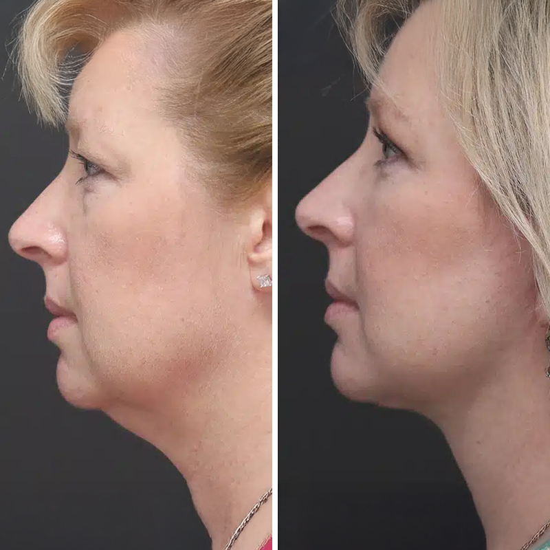 Before & After Photos Nicole Schrader, MD, FACS