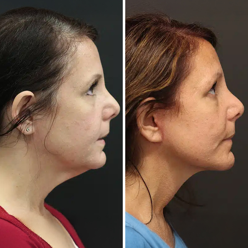 Before & After Photos Nicole Schrader, MD, FACS