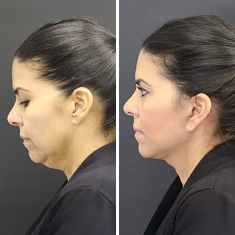 Before & After Photos Nicole Schrader, MD, FACS