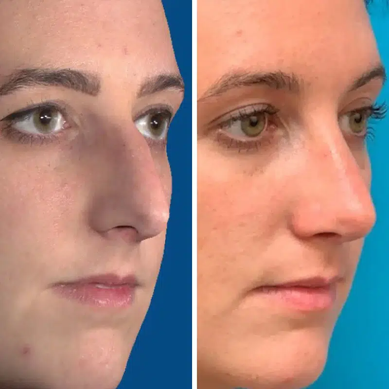 Before & After photos Dr. Becker