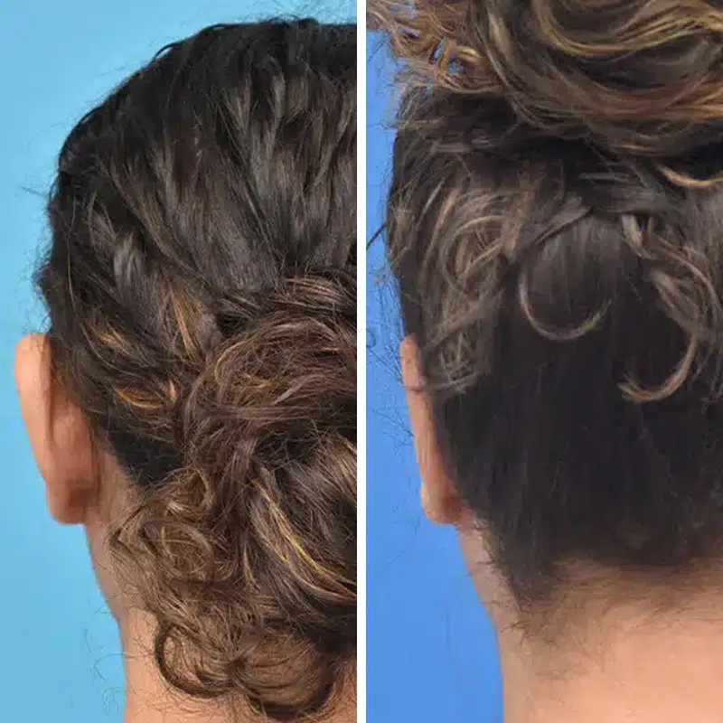 Before & After photos Dr. Becker