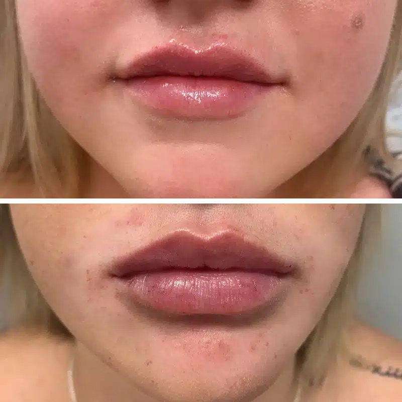 Before & After Photos Samantha Berry, RN