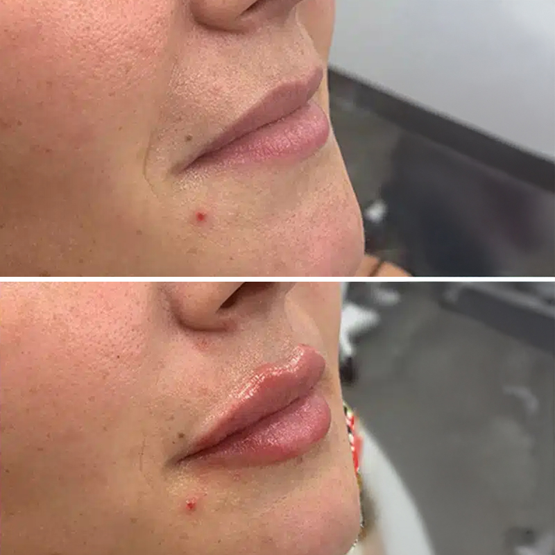 Before & After Photos Samantha Berry, RN