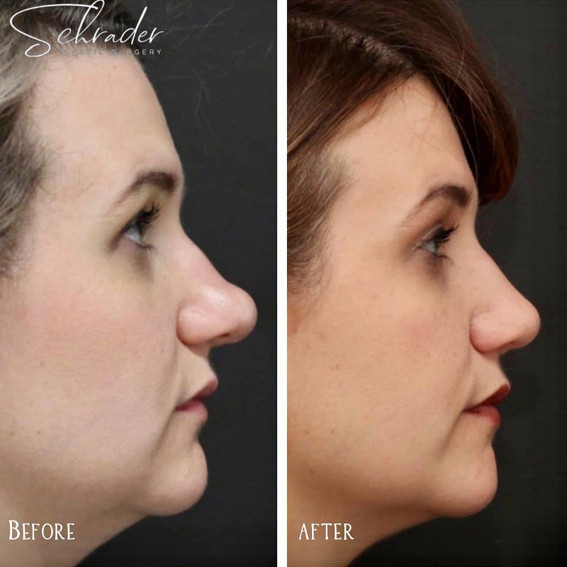 Before & After Photos Nicole Schrader, MD, FACS