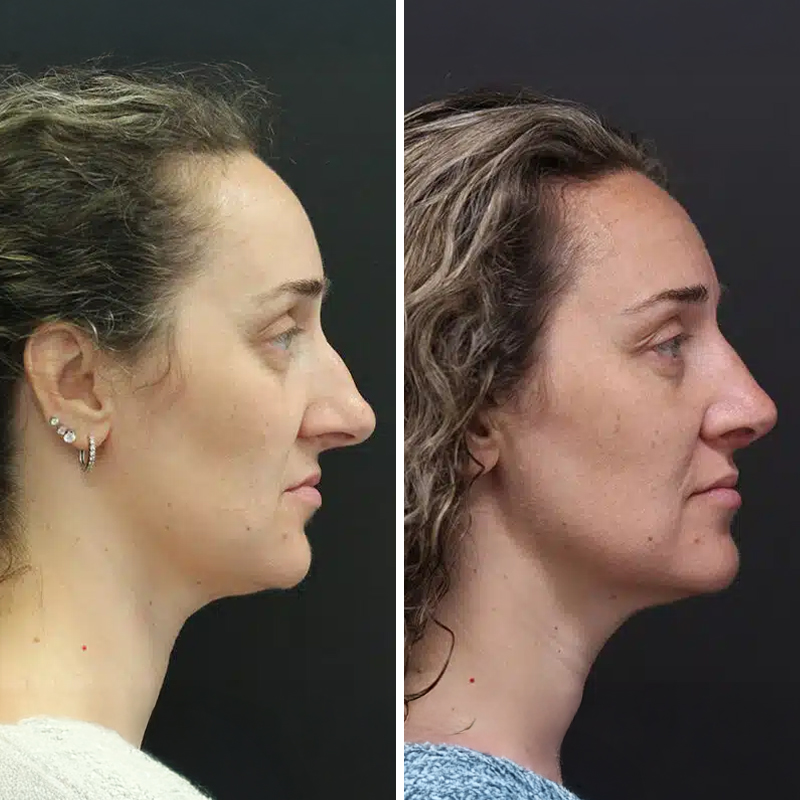 Before & After Photos Nicole Schrader, MD, FACS