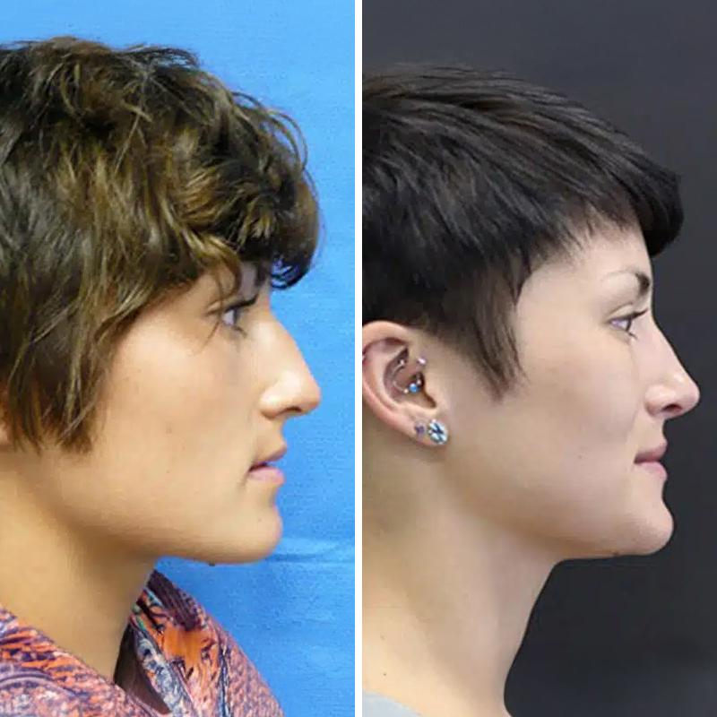 Before & After Photos Nicole Schrader, MD, FACS