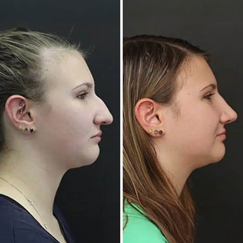 Before & After Photos Nicole Schrader, MD, FACS