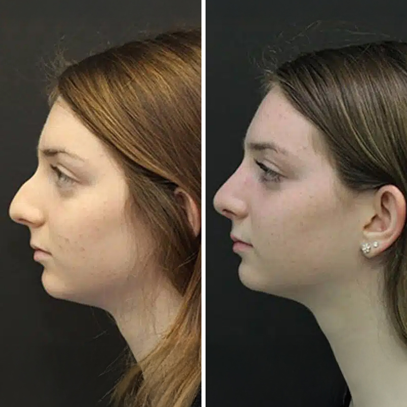 Before & After Photos Nicole Schrader, MD, FACS