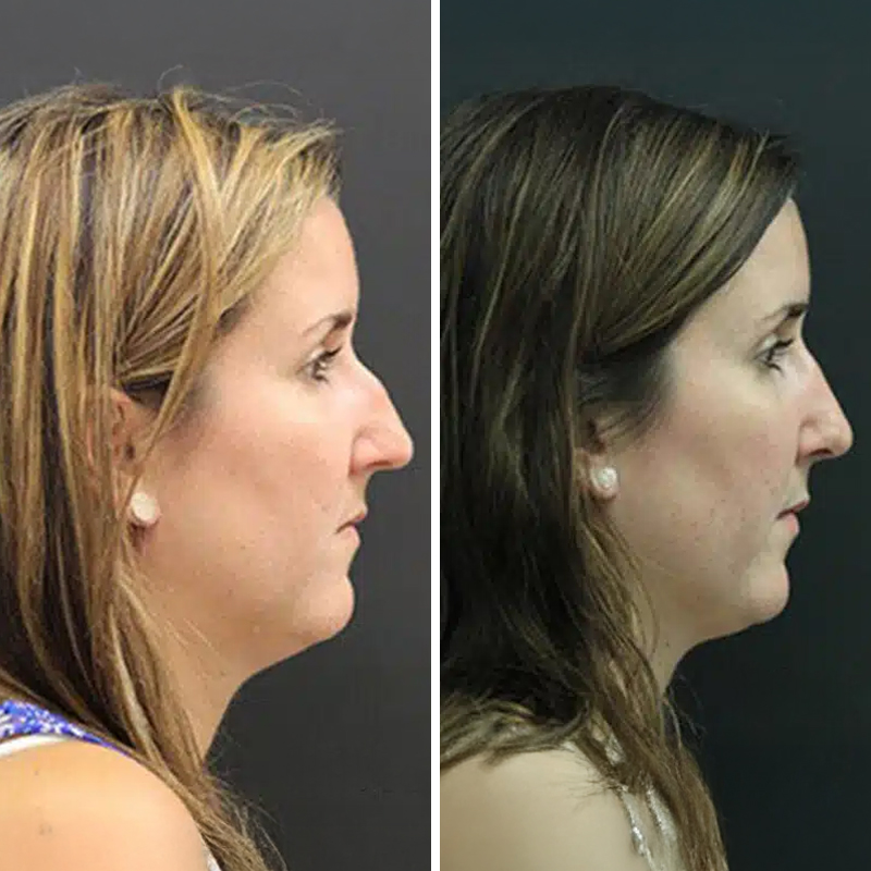 Before & After Photos Nicole Schrader, MD, FACS