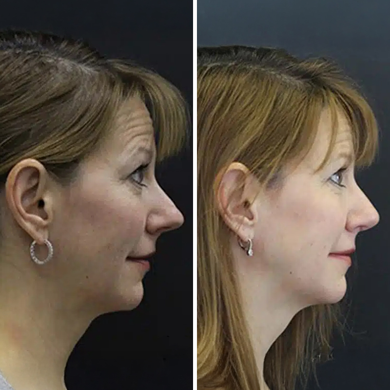Before & After Photos Nicole Schrader, MD, FACS