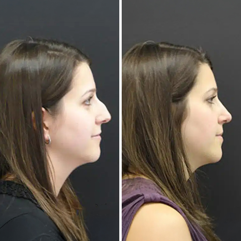 Before & After Photos Nicole Schrader, MD, FACS