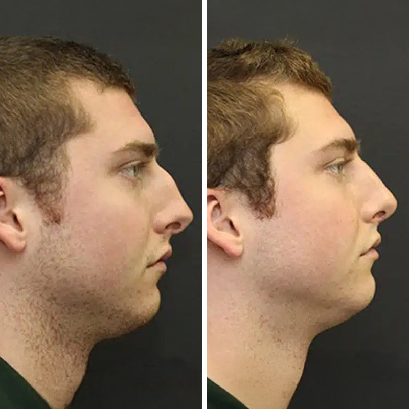 Before & After Photos Nicole Schrader, MD, FACS