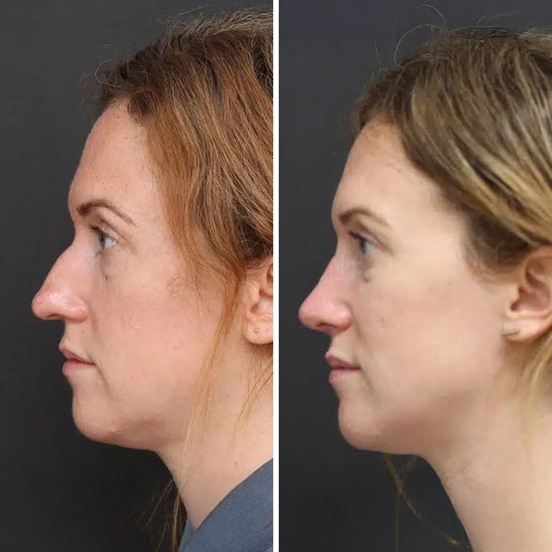 Before & After Photos Nicole Schrader, MD, FACS