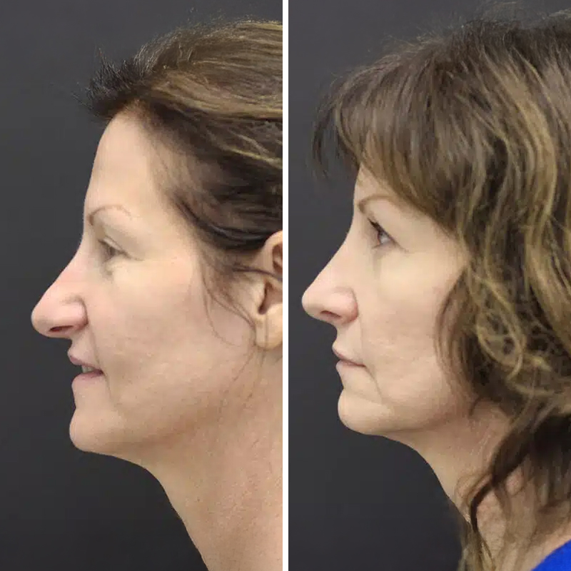 Before & After Photos Nicole Schrader, MD, FACS