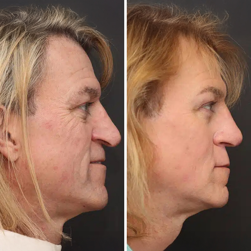 Before & After Photos Nicole Schrader, MD, FACS