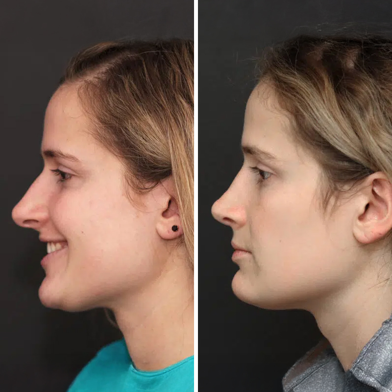 Before & After Photos Nicole Schrader, MD, FACS