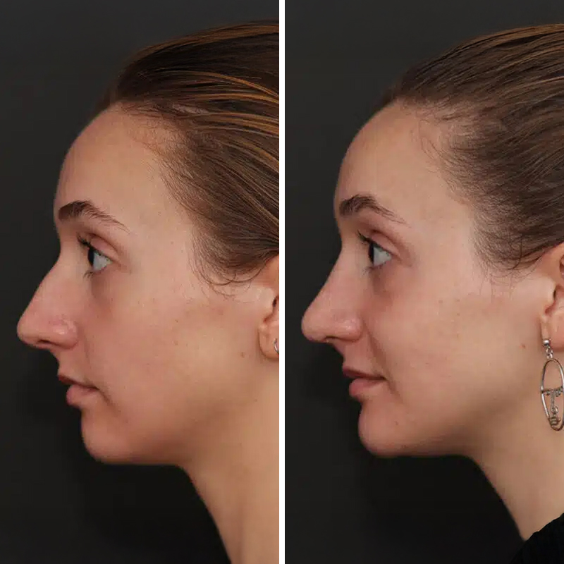 Before & After Photos Nicole Schrader, MD, FACS