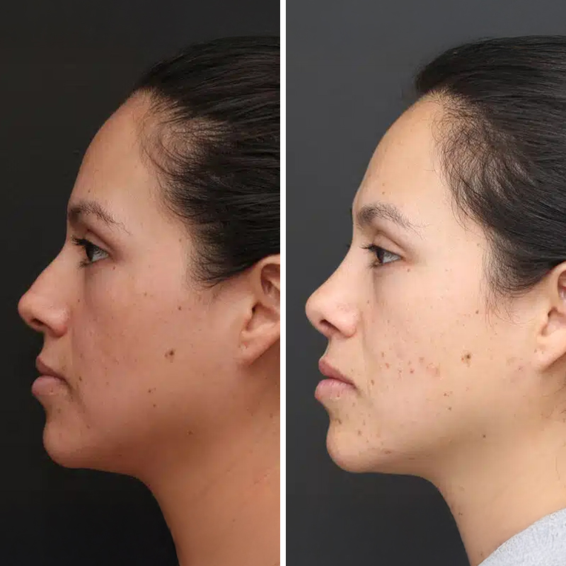 Before & After Photos Nicole Schrader, MD, FACS