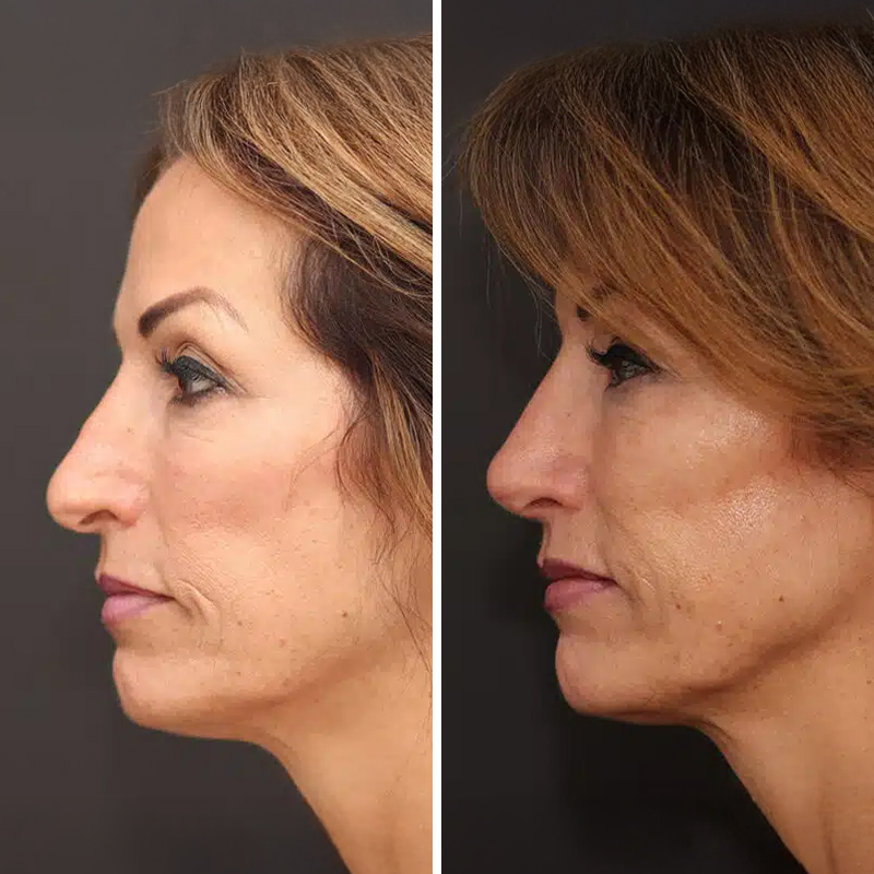 Before & After Photos Nicole Schrader, MD, FACS