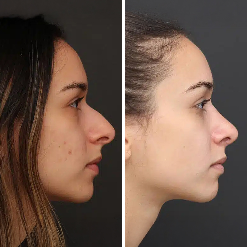 Before & After Photos Nicole Schrader, MD, FACS