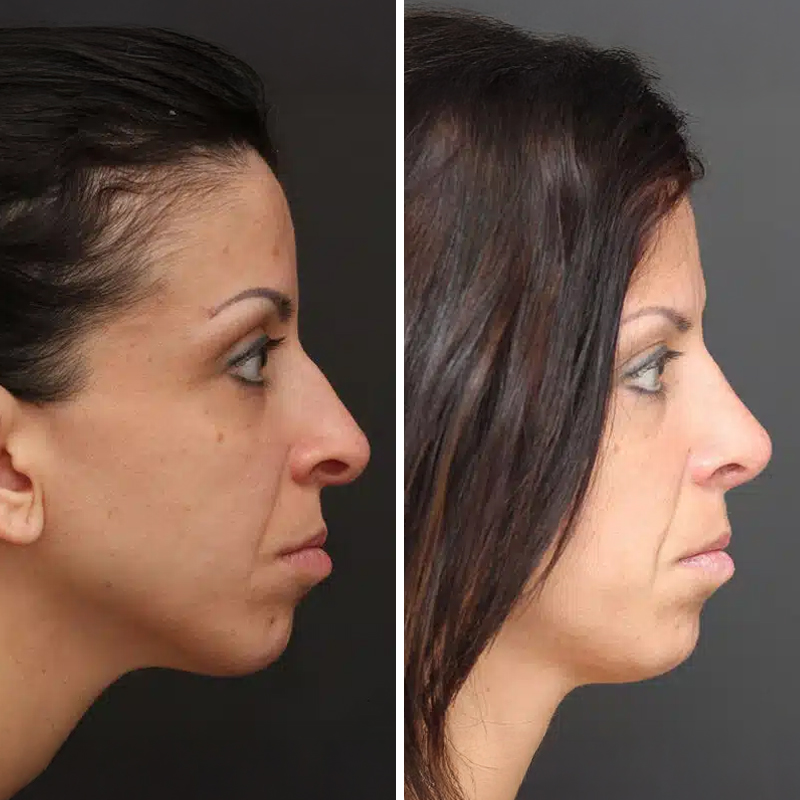 Before & After Photos Nicole Schrader, MD, FACS