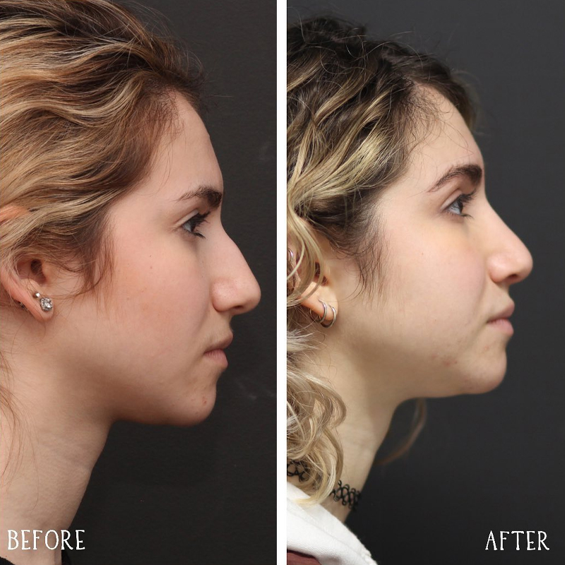 Before & After Photos Nicole Schrader, MD, FACS