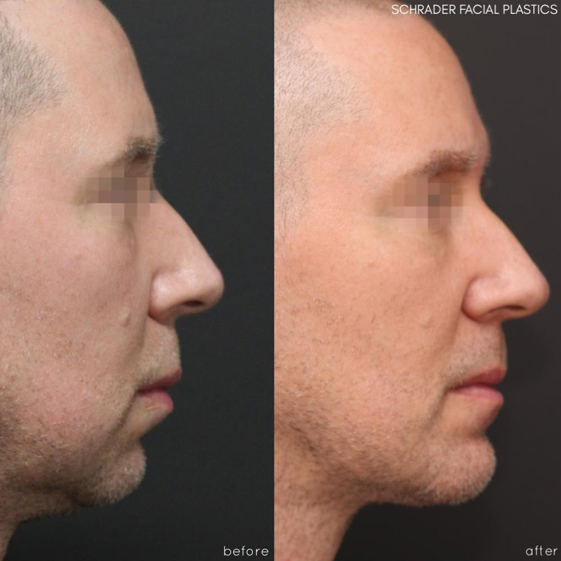 Before & After Photos Nicole Schrader, MD, FACS