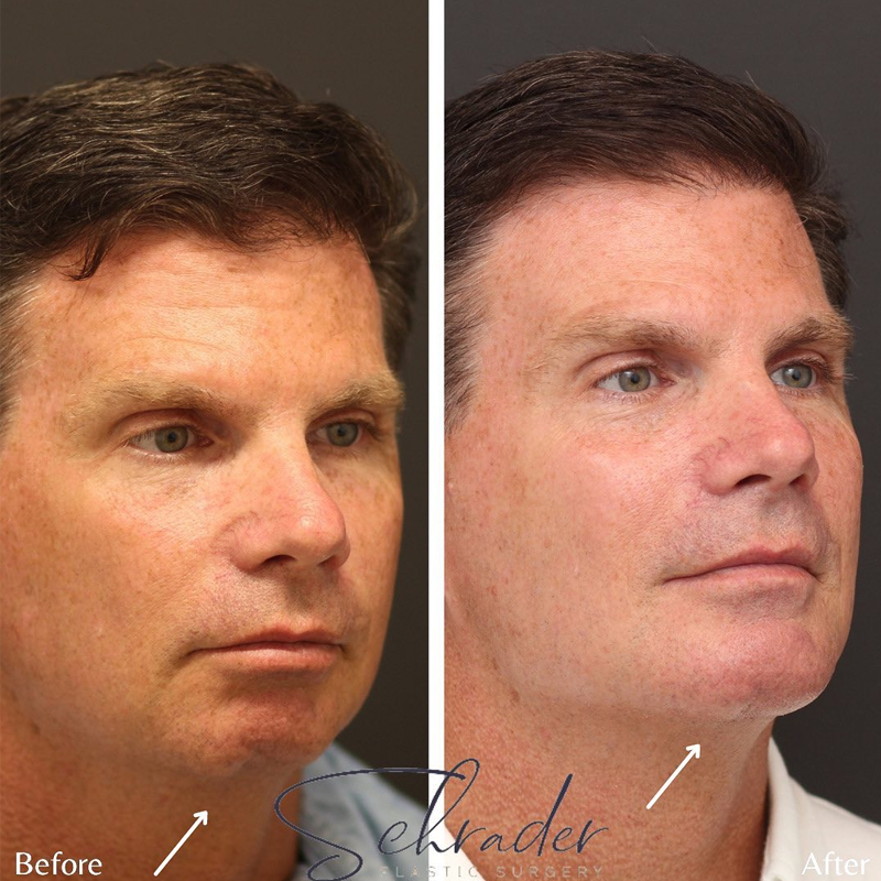 Before & After Photos Nicole Schrader, MD, FACS