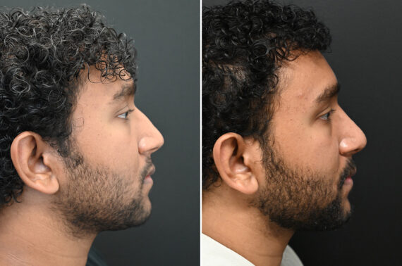 Rhinoplasty Before and After Photos in Princeton, NJ, Patient 9700
