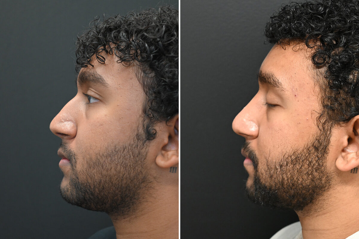 Rhinoplasty Before and After Photos in Princeton, NJ, Patient 9700