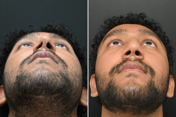 Rhinoplasty Before and After Photos in Princeton, NJ, Patient 9700