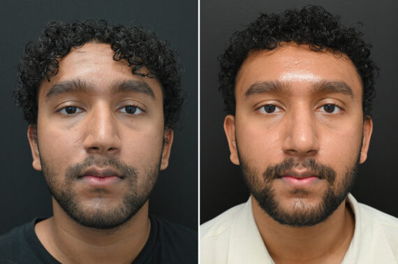 Rhinoplasty Before and After Photos in Princeton, NJ, Patient 9700