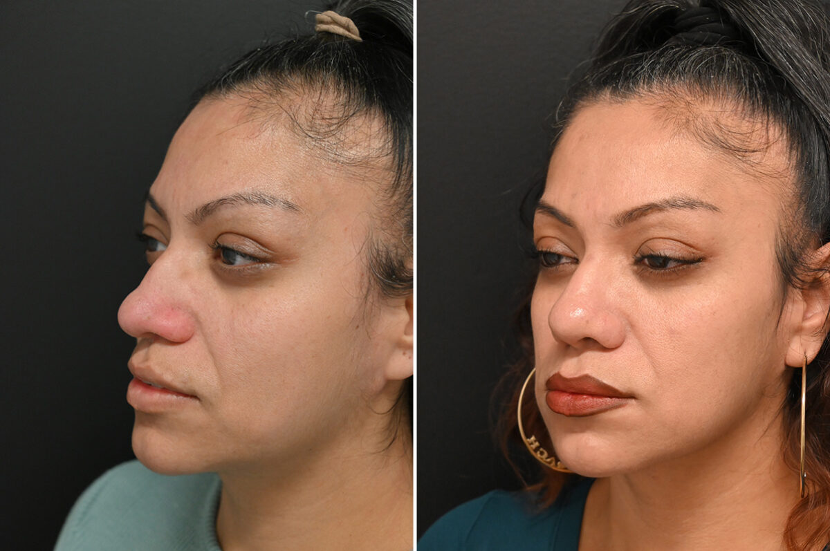 Revision Rhinoplasty Before and After Photos in Princeton, NJ, Patient 9713