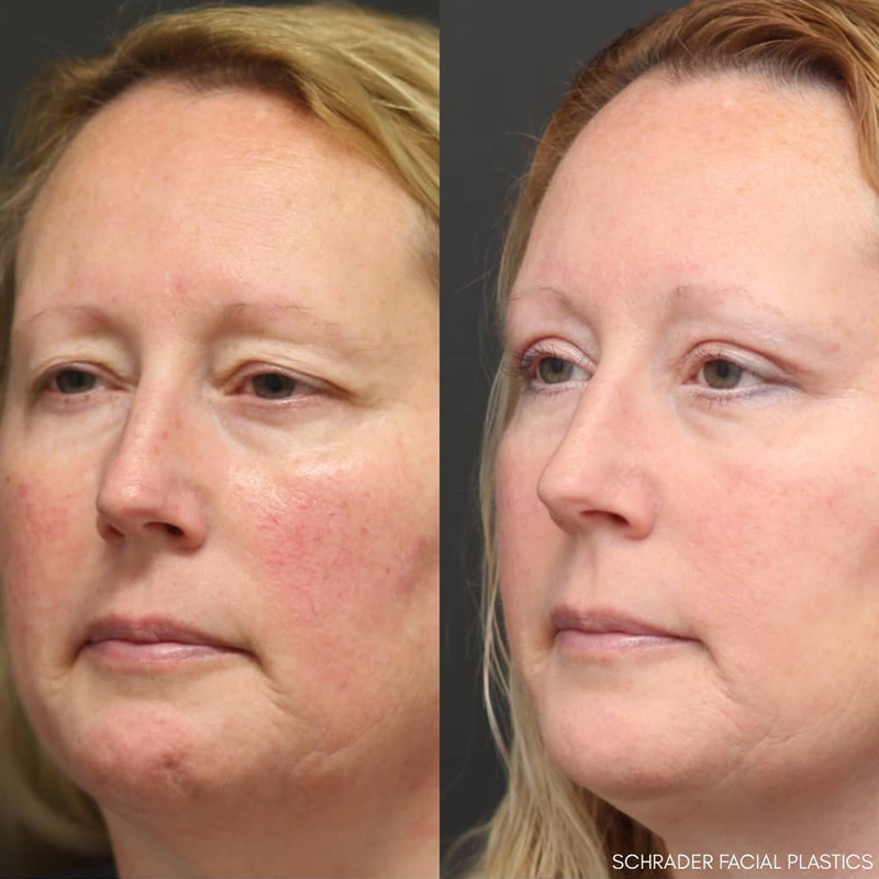 Before & After Photos Nicole Schrader, MD, FACS