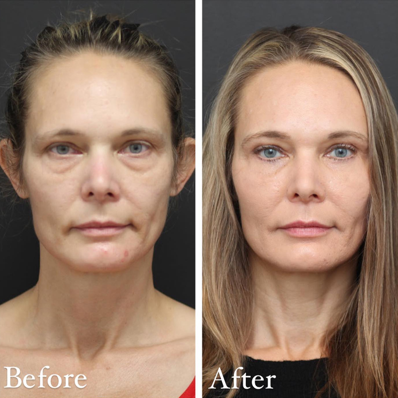 Before & After Photos Nicole Schrader, MD, FACS