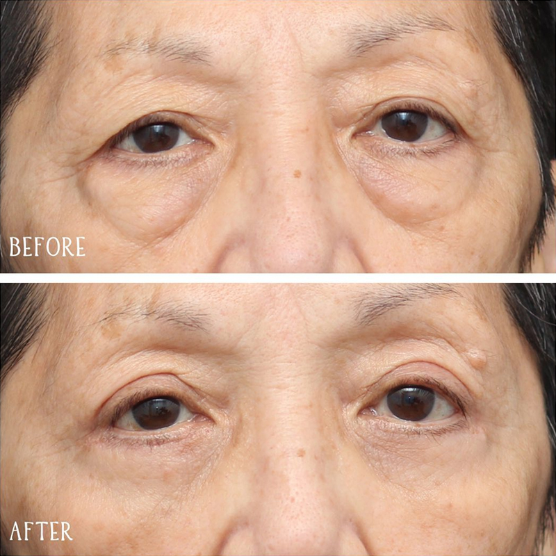 Before & After Photos Nicole Schrader, MD, FACS